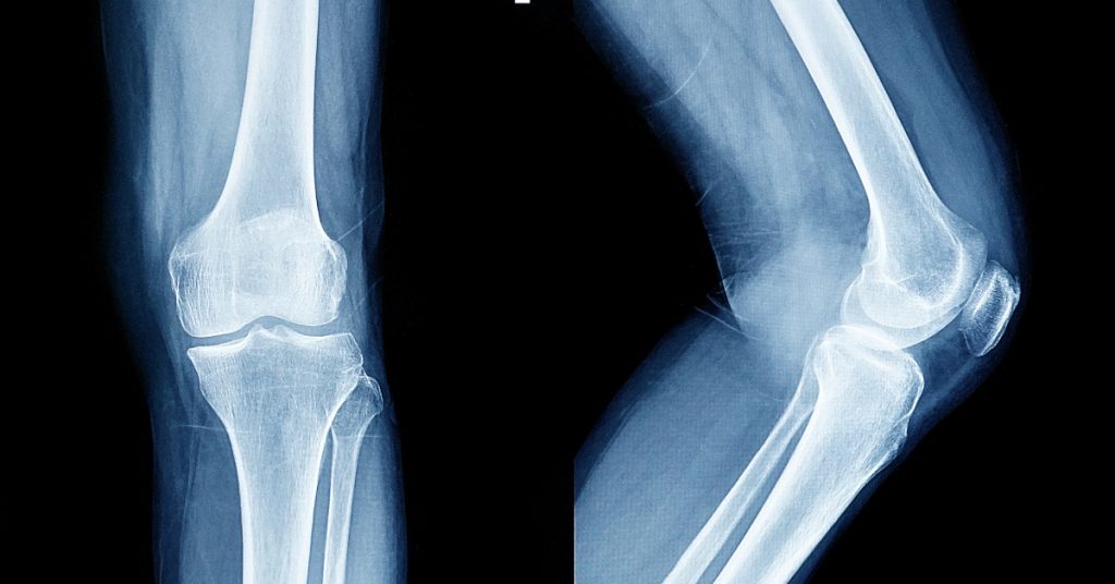Zdjęcie rentgenowskie kolan