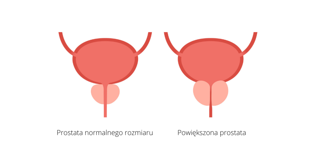 Schemat prostaty normalnego rozmiaru i powiększonej prostaty